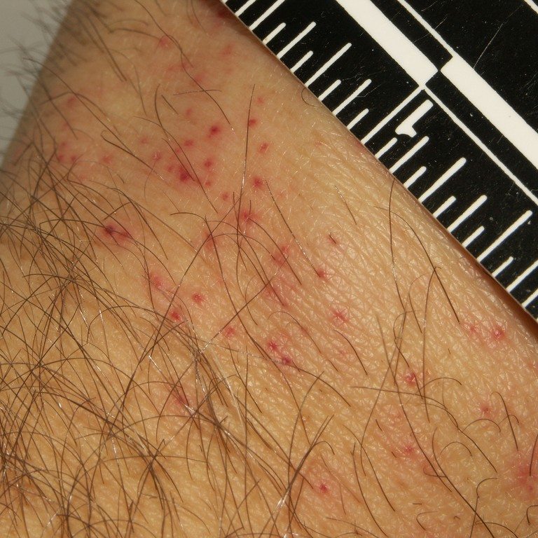 Bed Bug Bites